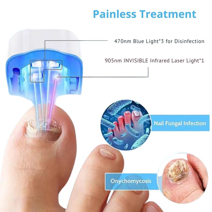 Nail Fungal Laser