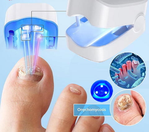 Nail Fungal Laser
